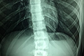  射线检测：揭秘其对人体健康的潜在影响
